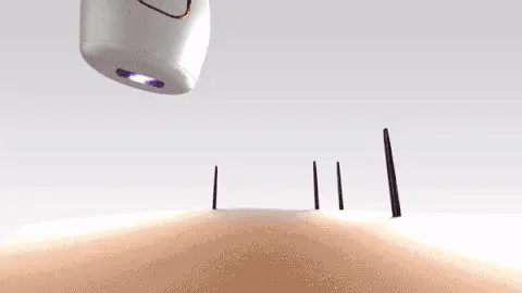 Mini Portable Laser Hair Removal Device | جهاز إزالة الشعر بالليزر المحمول